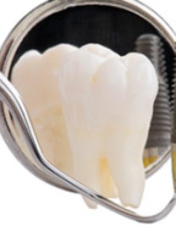 Dental Implants Melbourne