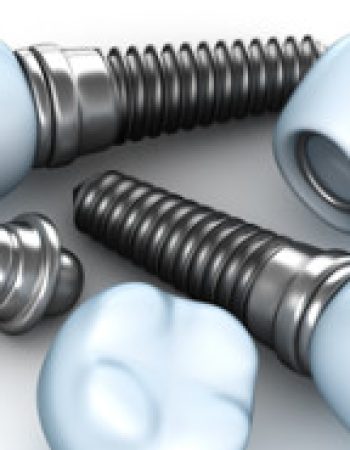 Dental Implants Melbourne