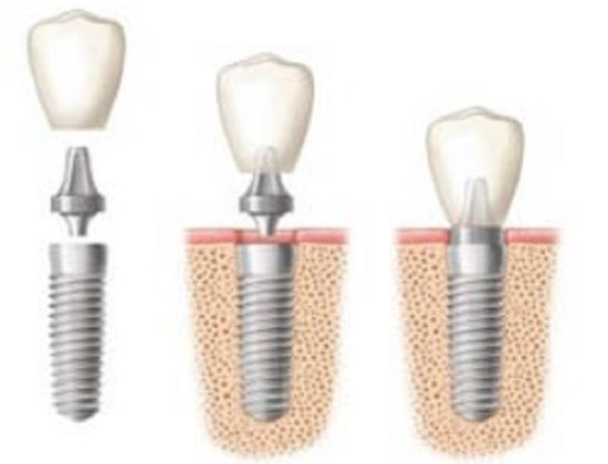 DENTAL IMPLANT PROFESSIONALS Sydney